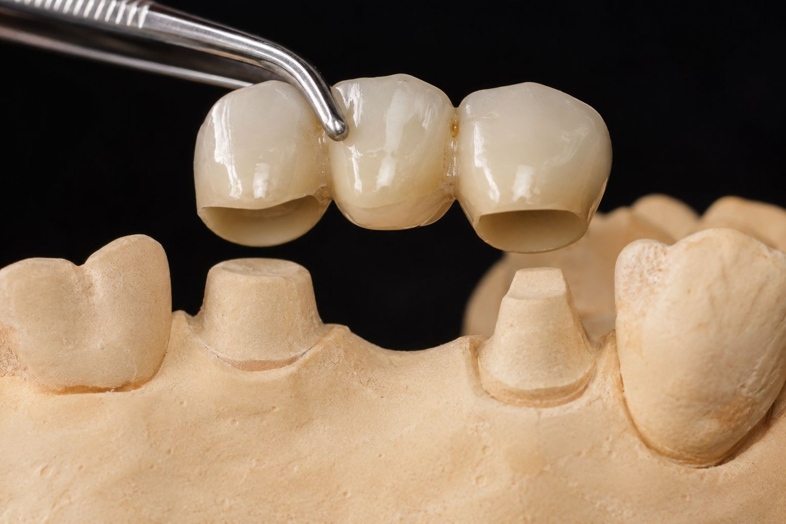 Three-unit dental bridge held above prepared teeth on a dental model