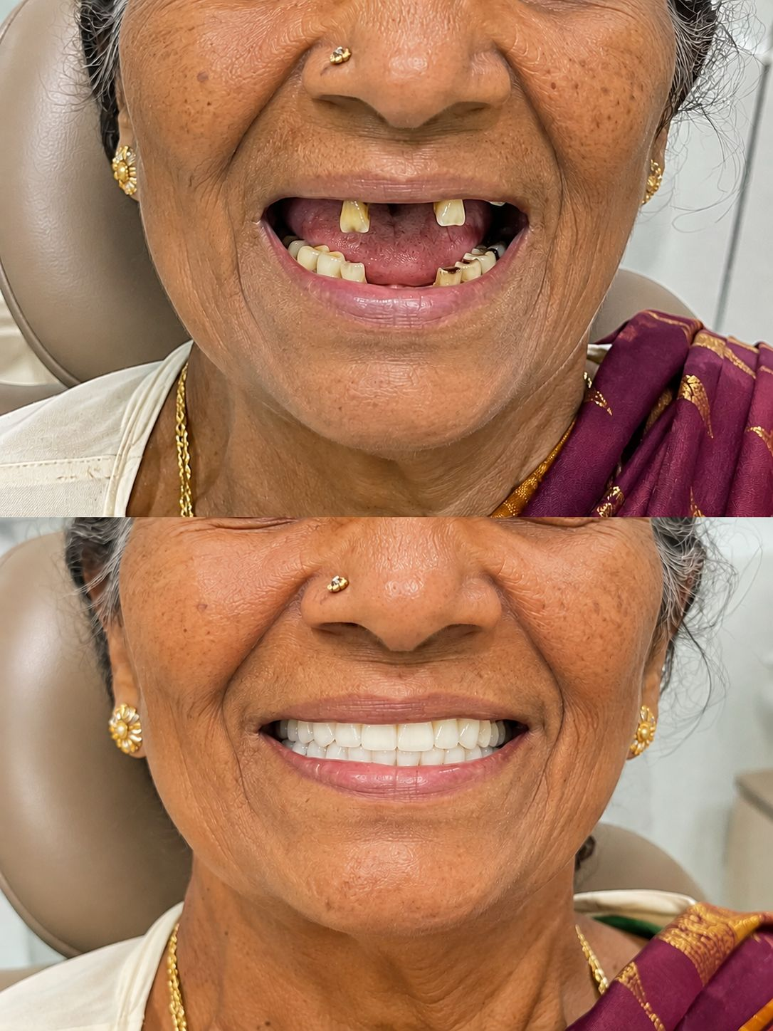 Dental implant before-and-after comparison: before treatment above and after treatment below